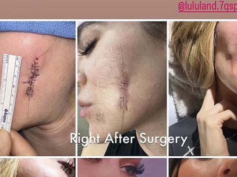 Array,Khloe Kardashian Bagikan Foto Mengerikan Bekas Jahitan Operasi Plastik