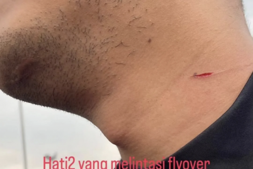 Cerita Pemotor Terjerat Benang Layangan, sampai Luka di Leher